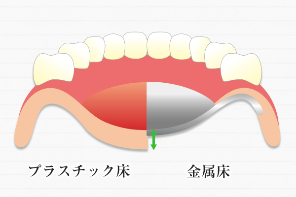 入れ歯の薄さの違いを説明するイラスト