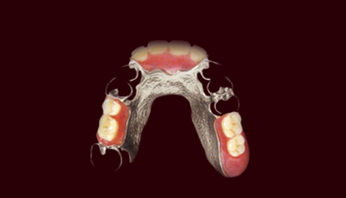 精密金属床義歯（コバルトクロム合金）の画像