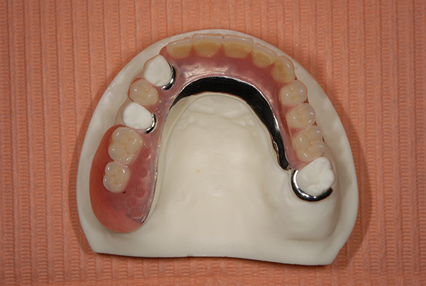 ミラクル義歯の画像