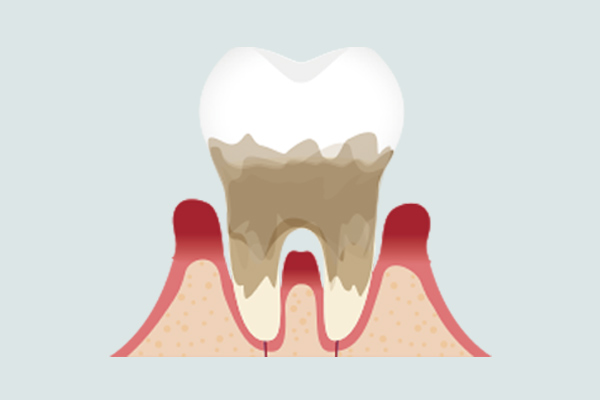 重度歯肉炎を説明するイラスト