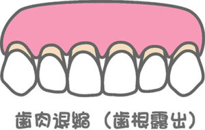 歯茎のイラスト