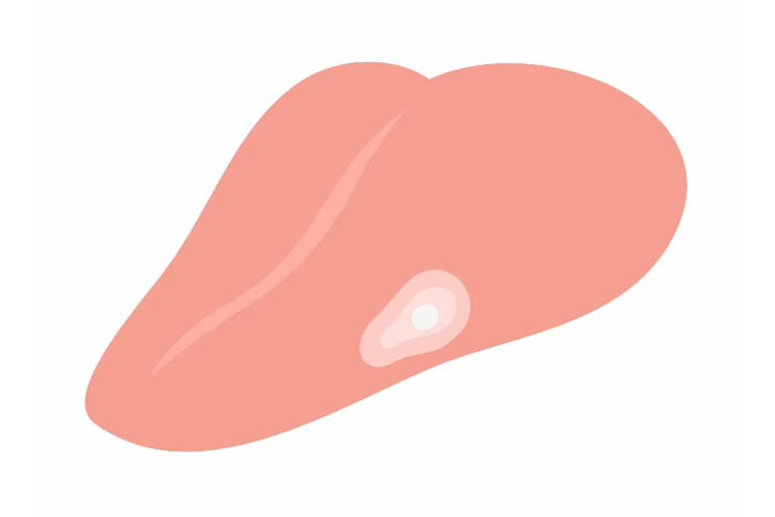 知っておきたいお口の病気「口腔がん」