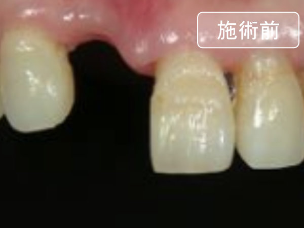 失われた歯の回復をするダイレクトボンディング治療例:治療前の写真